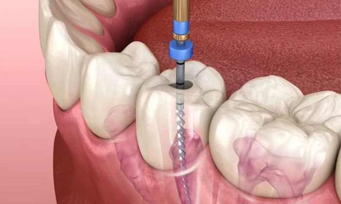 پر کردن دندان بعد از عصب کشی چقدر طول می کشد؟ | دکتر مهشید جمشیدی