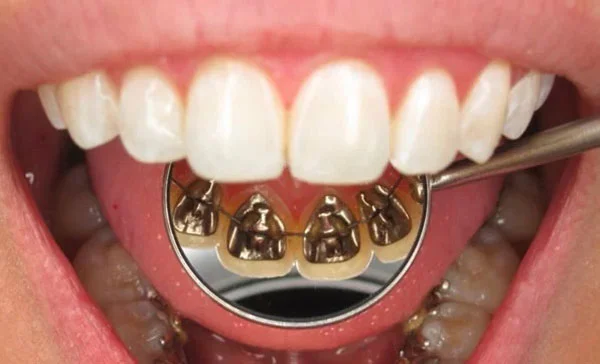 ارتودنسی پشت دندانی نامریی