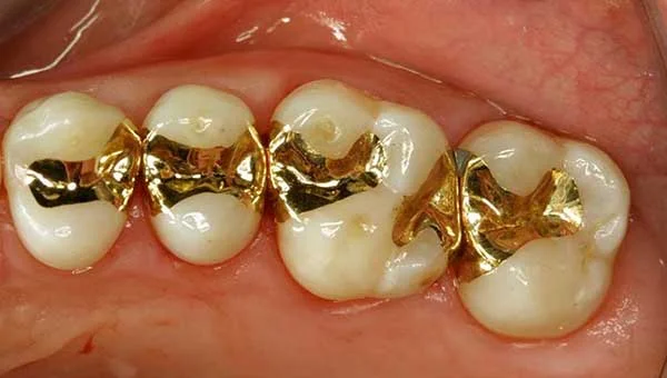 پرکردن دندان با طلا