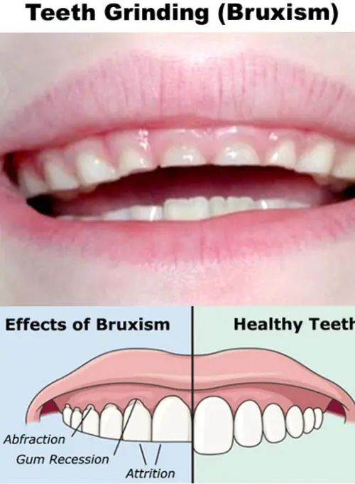 قبل و بعد از دندان قروچه
