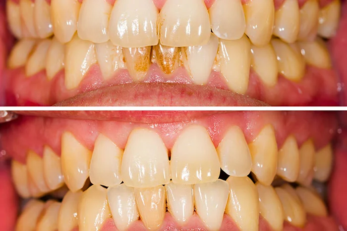 قبل و بعد از جرم گیری کردن دندان