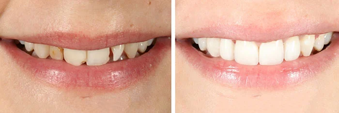 عکس دندان ها قبل و بعد از ونیر کامپوزیت