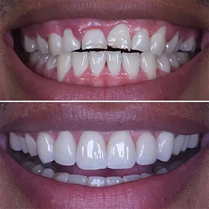 قبل و بعد از ونیر کامپوزیت دندان