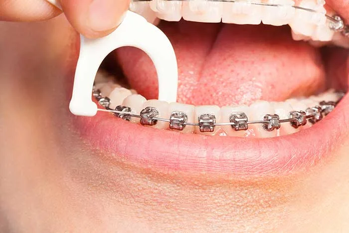 نخ دندان کشیدن ارتودنسی