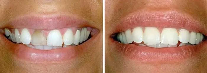 پوشش بدرنگی دندان با ونیر دندان