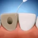 بلیچینگ داخلی دندان