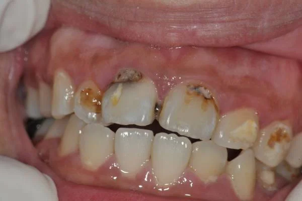 پوسیدگی دندان زیر ونیر کامپوزیت