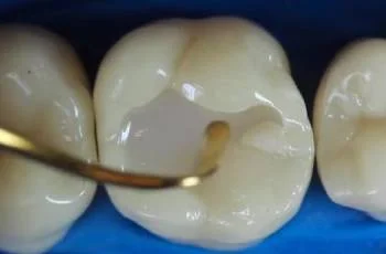 پر کردن دندان بعد از عصب کشی
