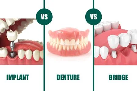 مقایسه پروتز متحرک و ثابت دندان