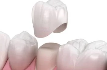 روکش دندان بعد از عصب کشی