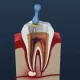 درمان عصب کشی دندان