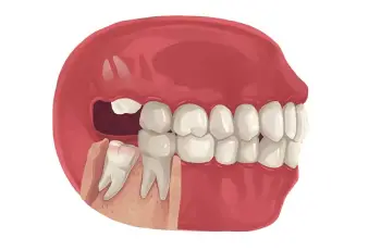 دوره نقاهت جراحی دندان عقل