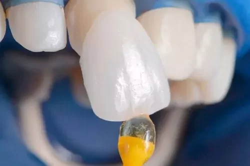 نکات مهم در رابطه با انواع چسب دندانپزشکی