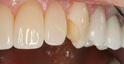 آیا کامپوزیت و لمینت باعث پوسیدگی دندان می_شود؟