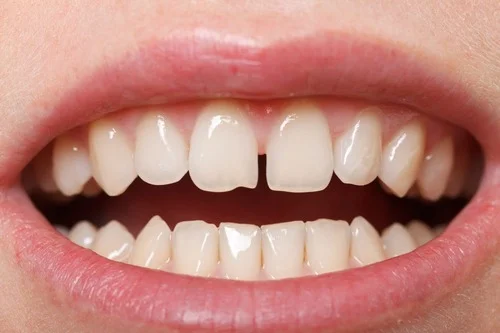 اصلاح فاصله خالی بین دندان