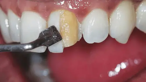 دلایل پوسیدگی کامپوزیت دندان