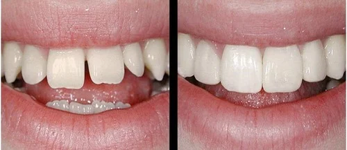 روش های اصلاح فاصله خالی بین دندان ها