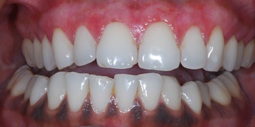 سیاه شدن لثه دندان بعد از ایمپلنت