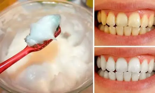 فرایند جرم گیری دندان خانگی چگونه است