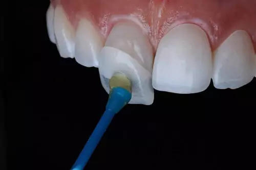 فرایند چسباندن روکش دندان با چسب قطره ای
